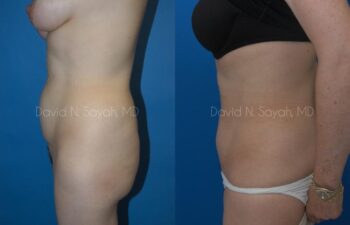 Tummy Tuck Before and After | Sayah Institute