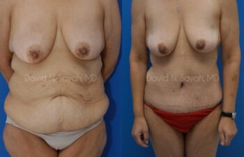 Tummy Tuck Before and After | Sayah Institute