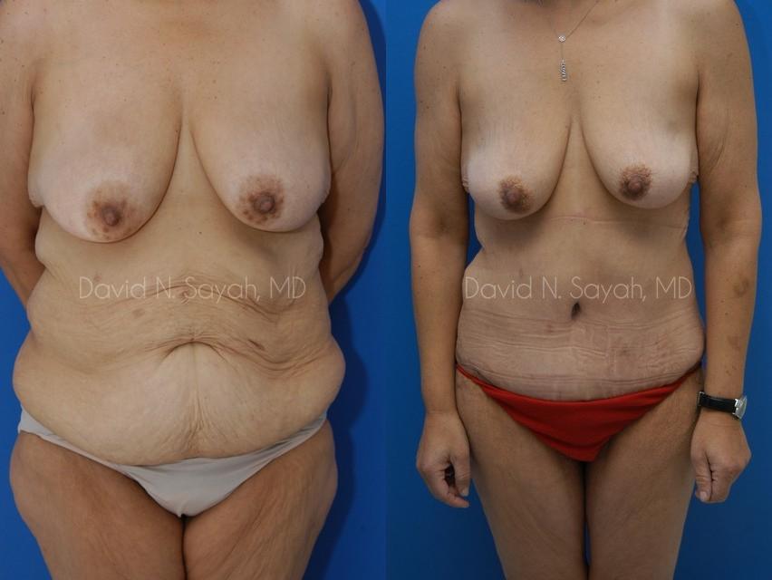 Tummy Tuck Before and After | Sayah Institute