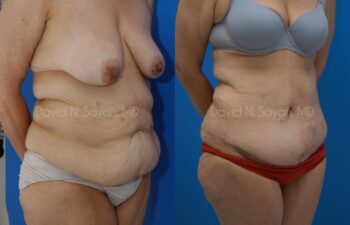 Tummy Tuck Before and After | Sayah Institute