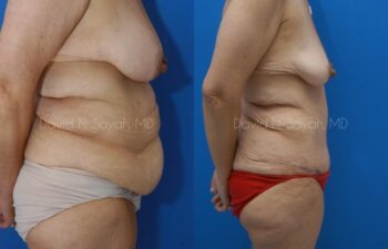 Tummy Tuck Before and After | Sayah Institute