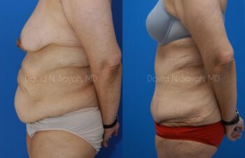 Tummy Tuck Before and After | Sayah Institute