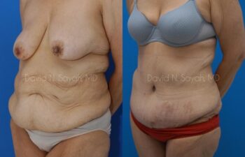 Tummy Tuck Before and After | Sayah Institute
