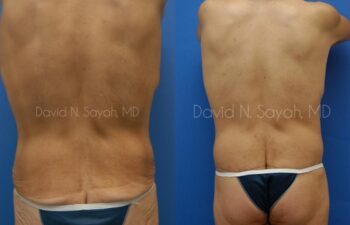 Back Tuck Belt Lipectomy Before and After | Sayah Institute