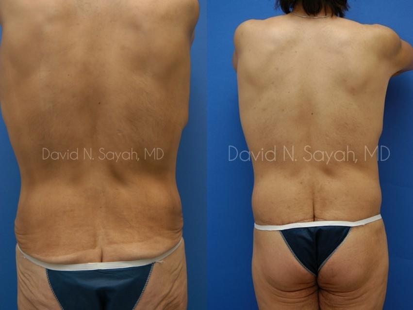 Back Tuck Belt Lipectomy Before and After | Sayah Institute