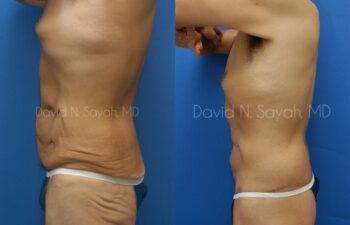 Back Tuck Belt Lipectomy Before and After | Sayah Institute