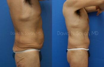 Back Tuck Belt Lipectomy Before and After | Sayah Institute
