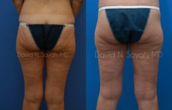Buttock Lift Before and After | Sayah Institute