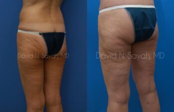 Buttock Lift Before and After | Sayah Institute