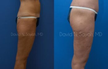 Buttock Lift Before and After | Sayah Institute