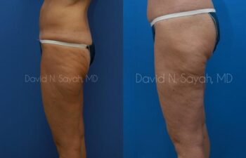 Buttock Lift Before and After | Sayah Institute