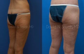 Buttock Lift Before and After | Sayah Institute