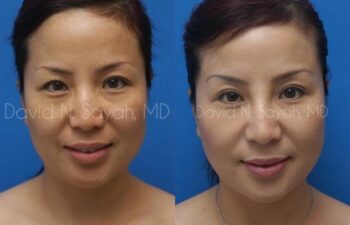 Eyelid Surgery Before and After | Sayah Institute