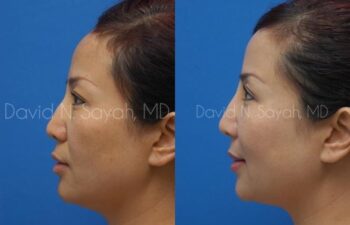 Eyelid Surgery Before and After | Sayah Institute