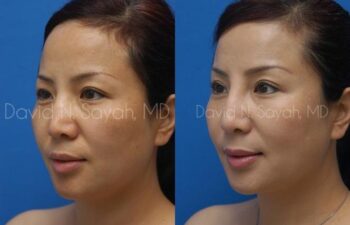 Eyelid Surgery Before and After | Sayah Institute