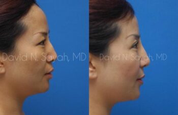 Eyelid Surgery Before and After | Sayah Institute
