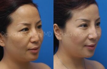 Eyelid Surgery Before and After | Sayah Institute