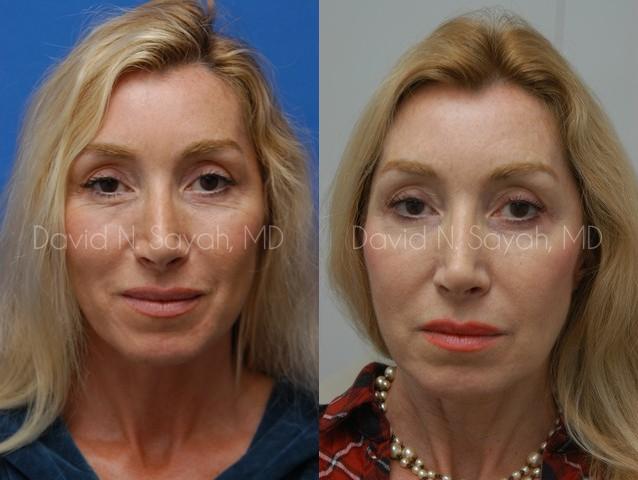 Fat Injection Face Before and After | Sayah Institute