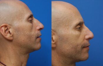 Rhinoplasty Before and After | Sayah Institute