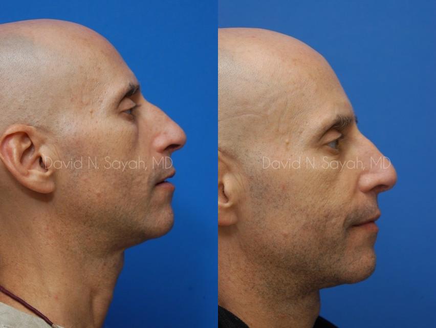 Rhinoplasty Before and After | Sayah Institute