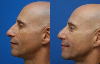 Rhinoplasty Before and After | Sayah Institute