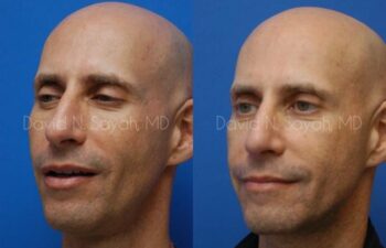 Rhinoplasty Before and After | Sayah Institute