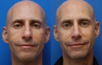 Rhinoplasty Before and After | Sayah Institute