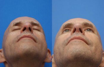 Rhinoplasty Before and After | Sayah Institute
