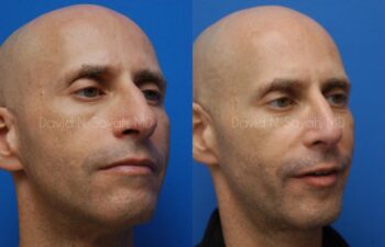 Rhinoplasty Before and After | Sayah Institute