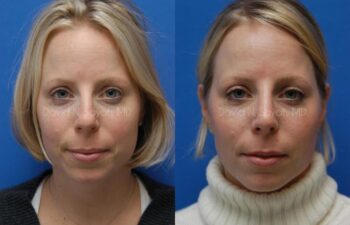 Rhinoplasty Before and After | Sayah Institute