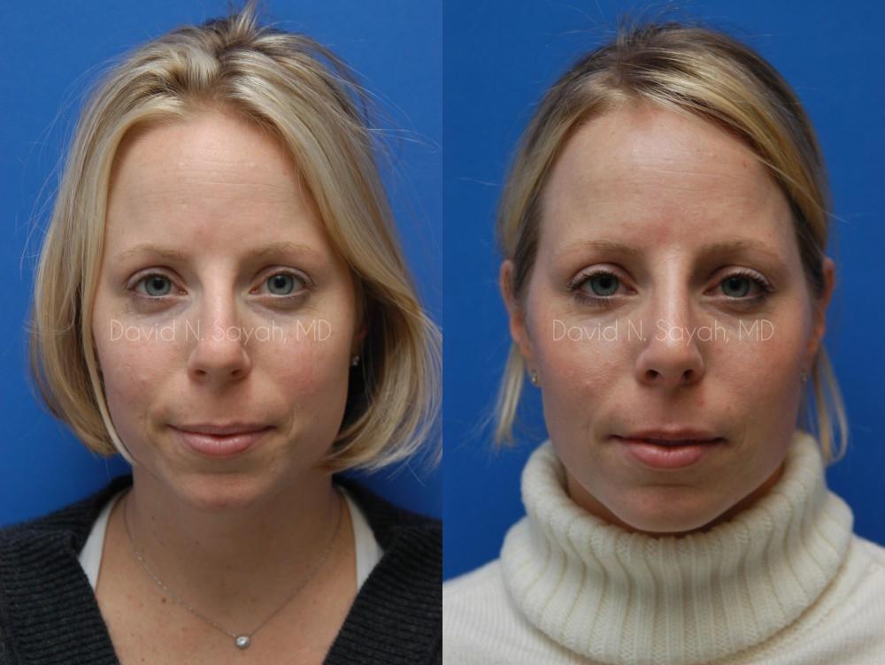 Rhinoplasty Before and After | Sayah Institute
