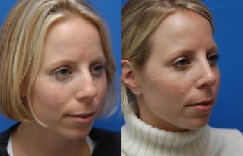 Rhinoplasty Before and After | Sayah Institute