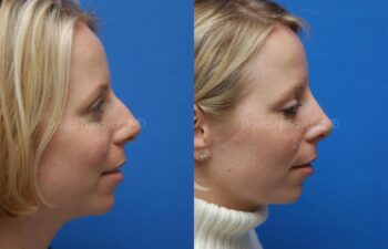 Rhinoplasty Before and After | Sayah Institute