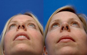 Rhinoplasty Before and After | Sayah Institute