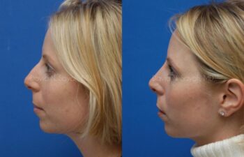 Rhinoplasty Before and After | Sayah Institute