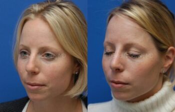 Rhinoplasty Before and After | Sayah Institute