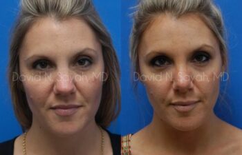 Rhinoplasty Before and After | Sayah Institute