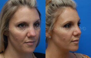 Rhinoplasty Before and After | Sayah Institute