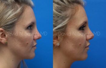 Rhinoplasty Before and After | Sayah Institute