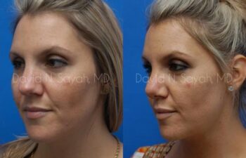 Rhinoplasty Before and After | Sayah Institute