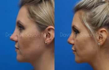 Rhinoplasty Before and After | Sayah Institute