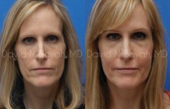 Rhinoplasty Before and After | Sayah Institute