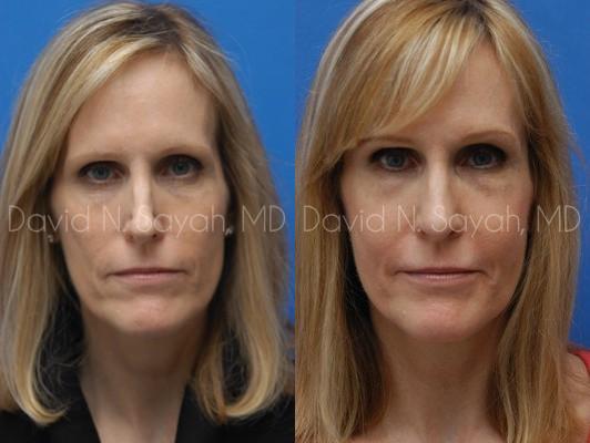 Rhinoplasty Before and After | Sayah Institute