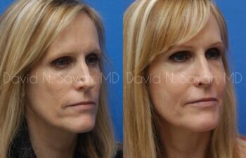 Rhinoplasty Before and After | Sayah Institute