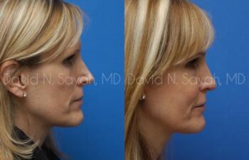 Rhinoplasty Before and After | Sayah Institute