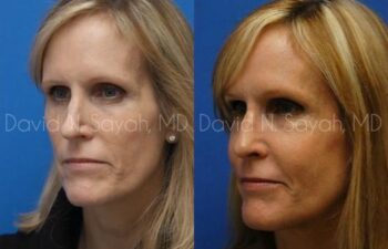 Rhinoplasty Before and After | Sayah Institute