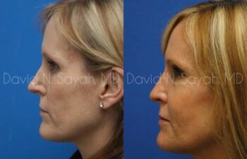 Rhinoplasty Before and After | Sayah Institute