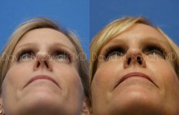 Rhinoplasty Before and After | Sayah Institute