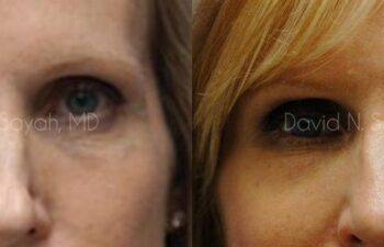 Rhinoplasty Before and After | Sayah Institute