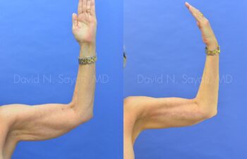 Brachioplasty Before and After | Sayah Institute